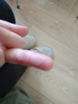 У девочки 8 лет на пальце трескается и воспаляется кожа фото 1