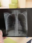 Рентген лёгких бронхиальная астма фото 1
