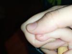 Сыпь на внешней стороне руки и пальцах у ребенка 2 лет фото 2