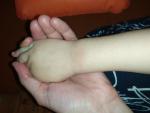 Сыпь на внешней стороне руки и пальцах у ребенка 2 лет фото 1