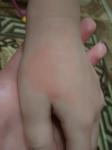 У ребенка 4 х лет красное пятно на руке фото 2