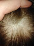 Точечки растущих волос на голове у ребёнка фото 2