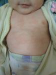 Атопический дерматит у младенца фото 1