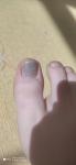 Серое пятно под ногтём на большом пальце ноги и боль фото 1