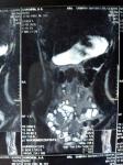 Снимок МРТ тонкого кишечника фото 1