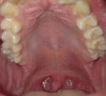 Красное горло, увеличенные миндалины, пятна не нёбе фото 2
