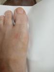 Косточка около большого пальца на ноге фото 1
