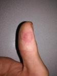 Проблема кожи пальцев фото 2