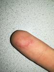 Проблема кожи пальцев фото 1