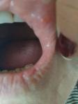 Язва на внутренней стороне губы фото 1