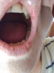 Язва на внутренней стороне губы фото 3