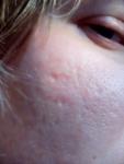 Пигментация вокруг губ, проблемная кожа фото 2
