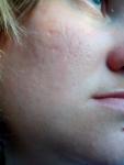 Пигментация вокруг губ, проблемная кожа фото 1