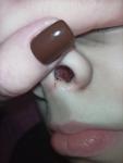 Кровь из носа у ребенка 13 лет фото 1