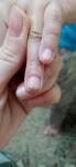Болячка на пальце и отслоение ногтя фото 1