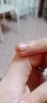 Болячка на пальце и отслоение ногтя фото 2