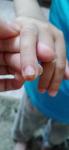 Болячка на пальце и отслоение ногтя фото 3