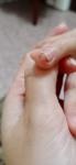 Болячка на пальце и отслоение ногтя фото 4