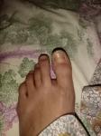Грибок ногтей на большом пальце ноги фото 2