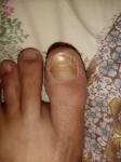 Грибок ногтей на большом пальце ноги фото 1