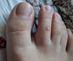 Нарост на пальце ноги фото 1