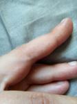 Белые пузырьки на пальцах рук фото 3