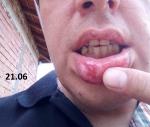 Воспаление губы фото 1
