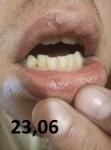 Воспаление губы фото 2