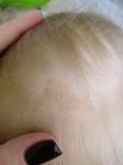 Красное пятно на голове у ребёнка фото 2