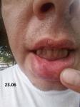 Воспаление губы фото 5