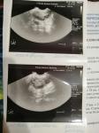 Завышен ттг и занижен прогестерон при планировании беременности фото 2