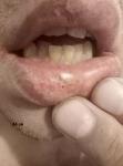 Воспаление губы фото 4