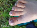 Мелкие пузырьки на пальцах ног фото 1