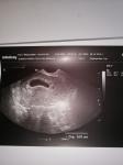 Беременность угрожающая аборт после узи фото 1