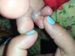 Зудящие прыщи на пальцах у ребенка фото 2