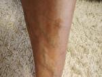 Коричневое пятно на ноге с рваными краями фото 1