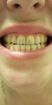 Почернение передних зубов фото 1