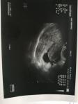 Субхориальная гематома срок 5 недель беременности фото 4