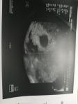 Субхориальная гематома срок 5 недель беременности фото 3