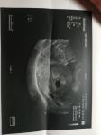 Субхориальная гематома срок 5 недель беременности фото 2
