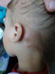 Лимфоузел за ухом у ребенка фото 1