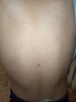 Сыпь на теле ребенка на животе на спинее и шее фото 1