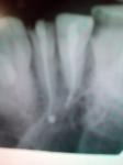 Как удалить лишний пм за корнем зуба? фото 1