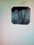 Как удалить лишний пм за корнем зуба? фото 2