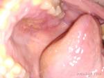 Воспаление и отёк нёба и десны фото 2