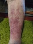 Отек ног с последующей аллергией фото 1