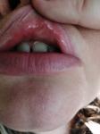 Шишка на внутренней стороне губы фото 3