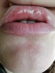 Шишка на внутренней стороне губы фото 4