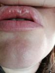 Шишка на внутренней стороне губы фото 2