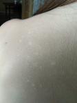 Маленькие, белые пятнышки у ребёнка на спине фото 2